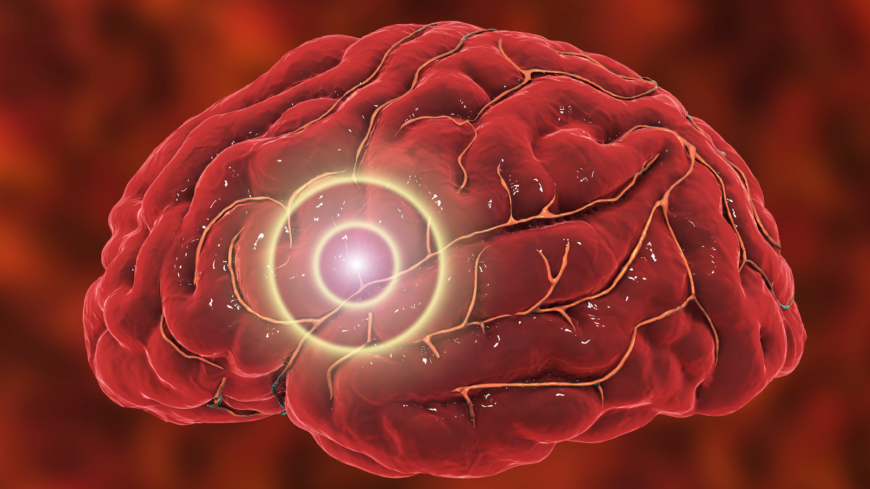 Der er teorier om, at hjernestammen og trigeminusnerven er indblandet.  Foto: Shutterstock